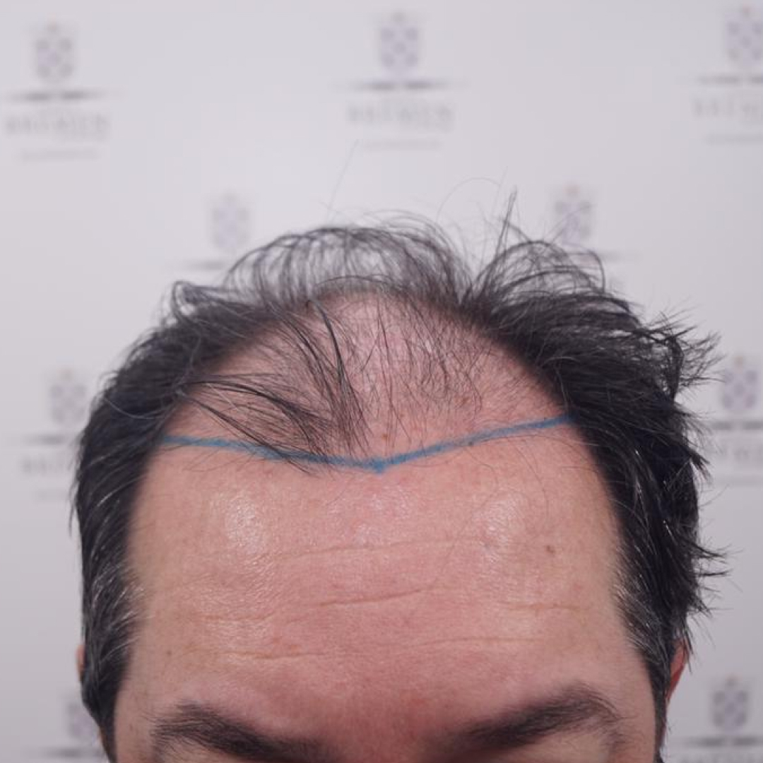 Antes 1 Antes 1