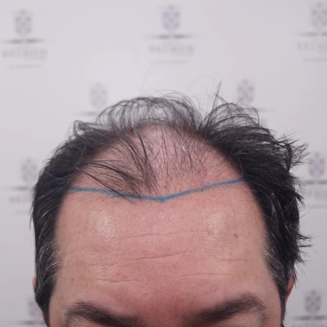 Antes 1 Antes 1