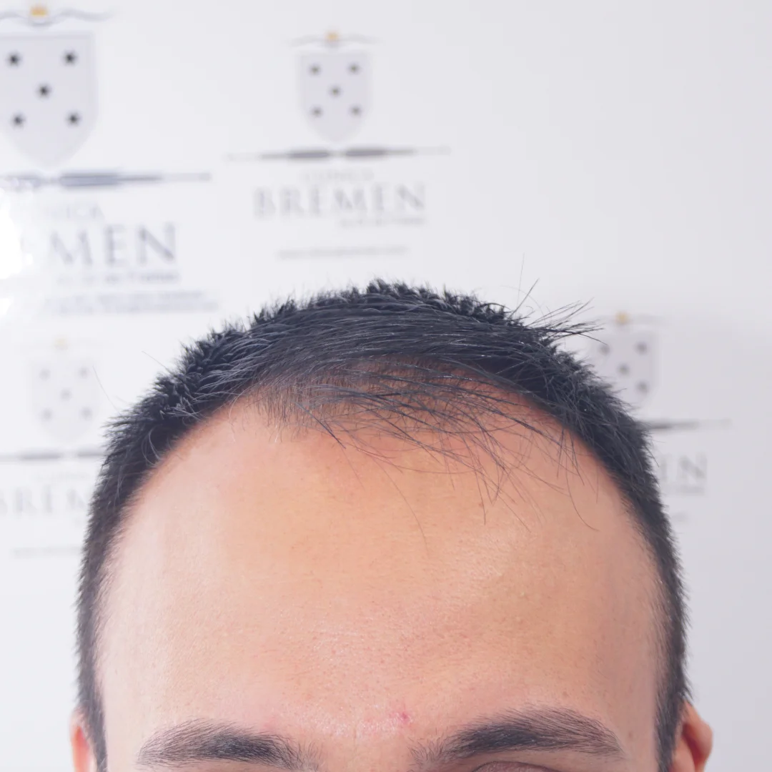 Antes 3 Antes 3